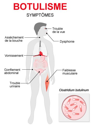 Allo Docteur - Le botulisme