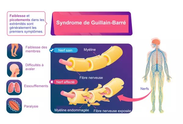 Allo docteur : Le syndrome de Guillain-Barré