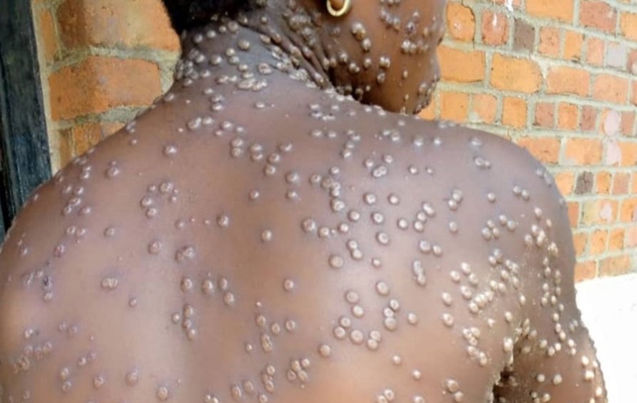 Allo docteur : La variole